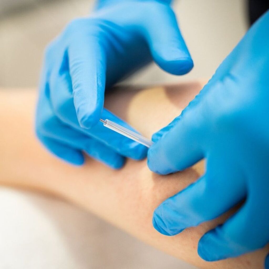 igłoterapia Częstochowa