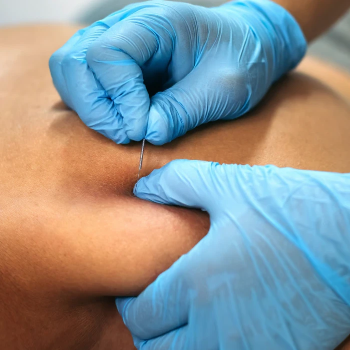 igłoterapia sucha w&nbsp;częstochowie