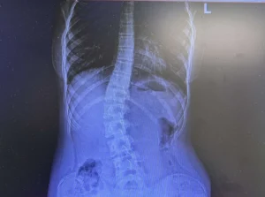 prześwietlenie rentgenowskie osoby ze skoliozą - przyniesiono je do gabinetu rehabilitacji i fizjoterapii w częstochowie