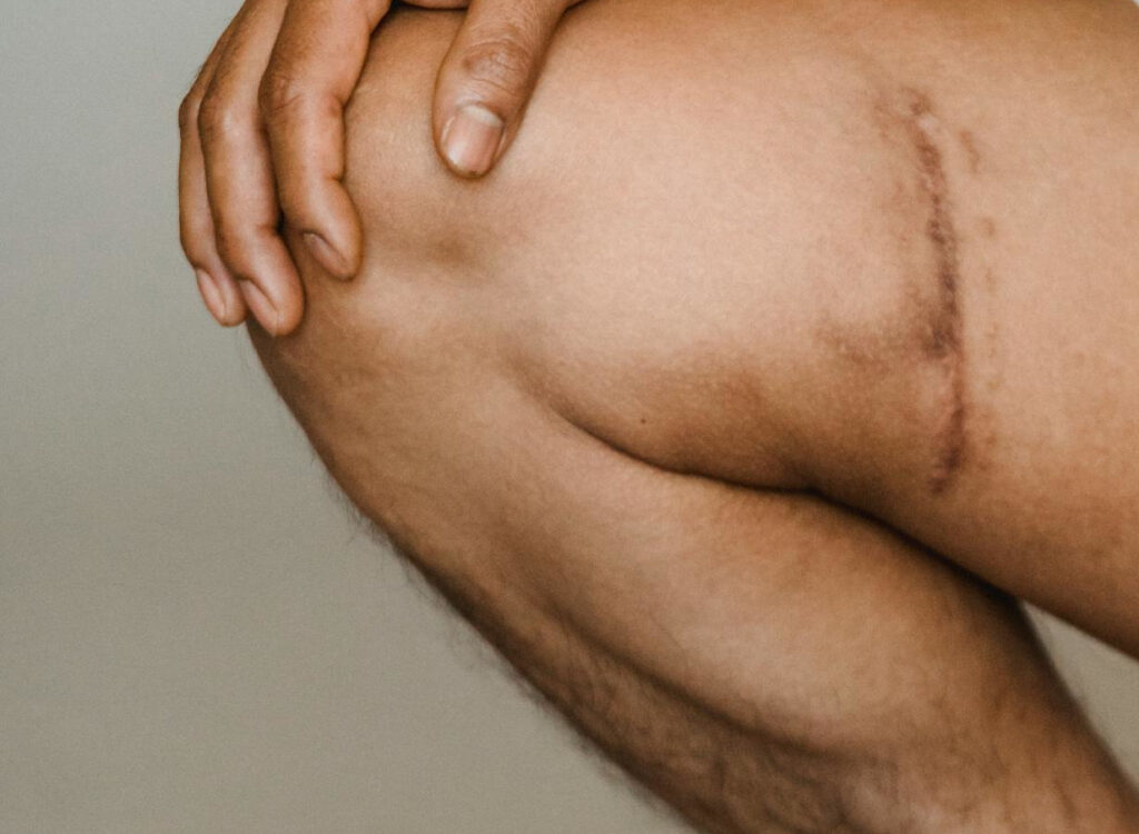 terapia blizny - mężczyzna z blizną na nodze szuka pomocy u fizjoterapeuty w Częstochowie